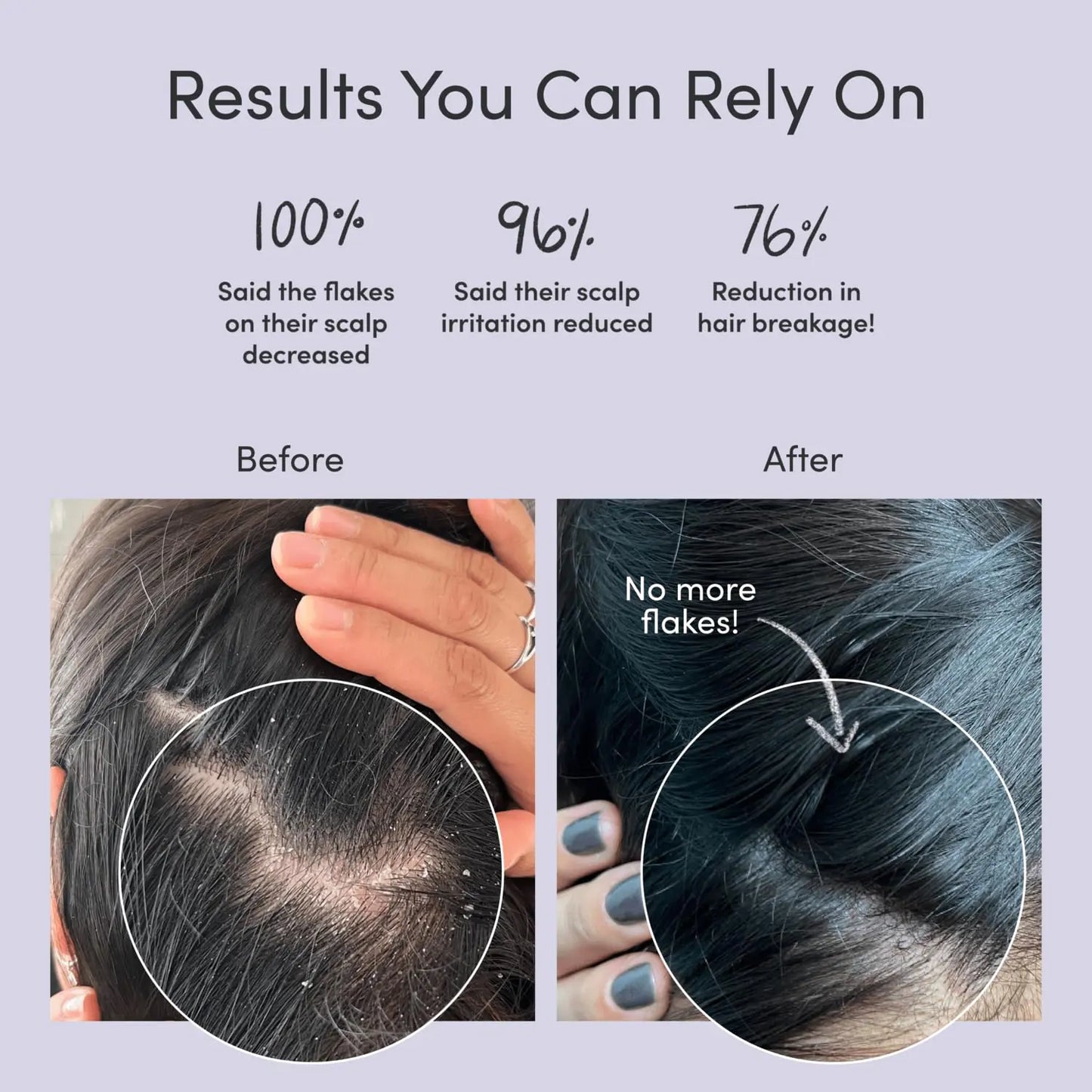 Anti Dandruff Shampoo For Women & Men - For Flaky, Itchy, Oily, Dry Scalp