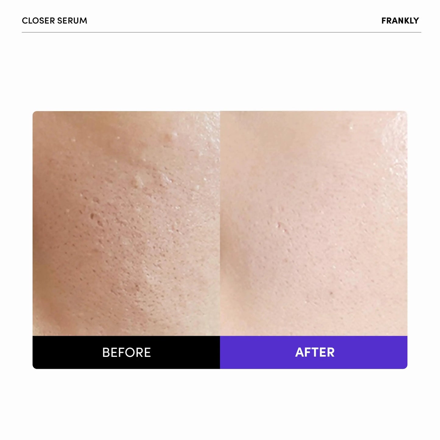 Frankly Closer Serum - Pore Minimizing, Anti-Aging, Elasticity, Hydration, Plump & Dewy Skin - All skin types