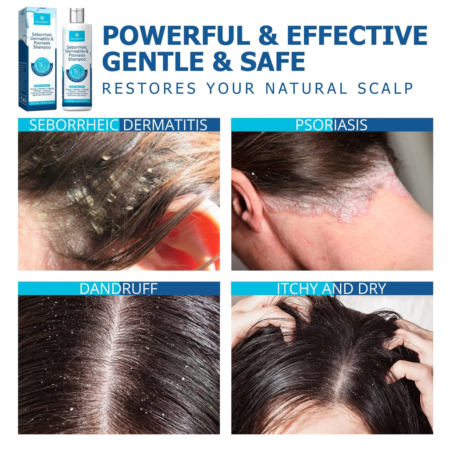 Roycederm Psoriasis Shampoo, Dandruff Shampoo, Dry Itchy Scalp Treatment